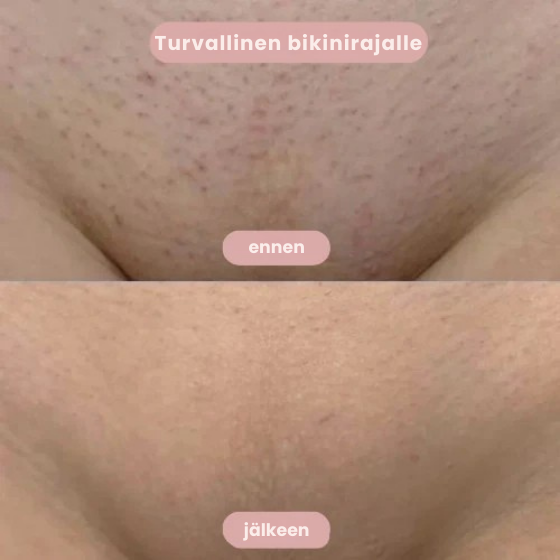 SilkySkin – Intiimialueiden karvanpoisto ilman ärsytystä